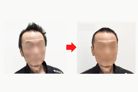 薄毛オシャレ坊主